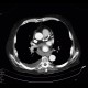 Pulmonary tuberculosis, TBC, tuberculosis: CT - Computed tomography